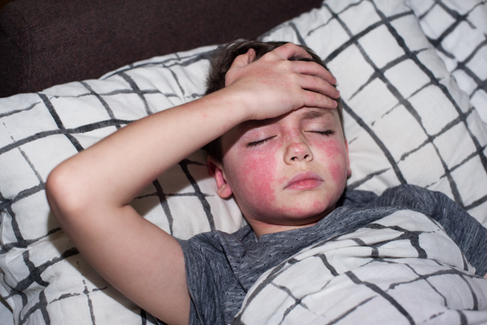 Niño con escarlatina tumbado en la cama. 