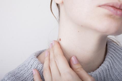 Mujer con verruga en el cuello